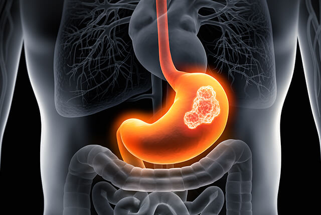 胃がんのイメージ